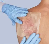Medisorb H Pansament cu Hidrocoloid 15×15 cm